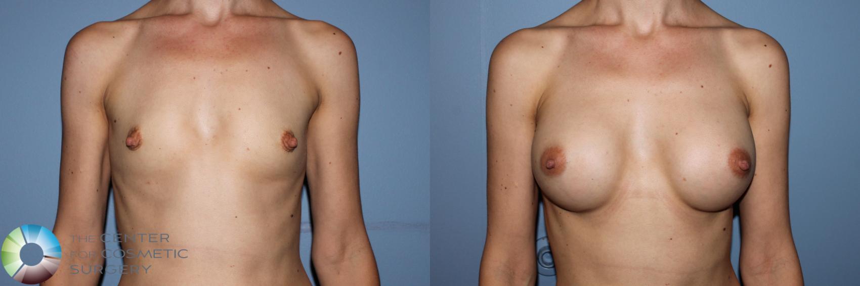 Before & After Breast Augmentation Case 11703 Front in Denver and Colorado Springs, CO