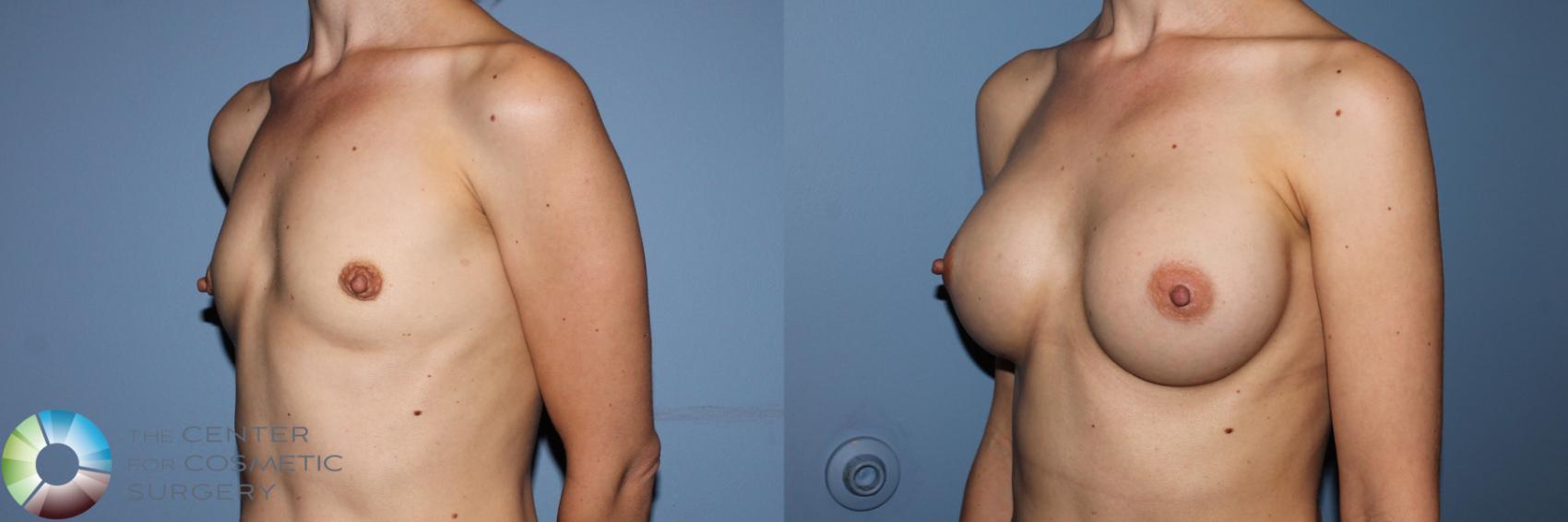 Before & After Breast Augmentation Case 11703 Left Oblique View in Golden, CO