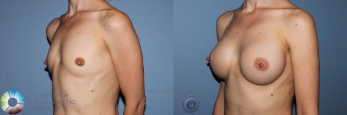 Before & After Breast Augmentation Case 11703 Left Oblique View in Golden, CO