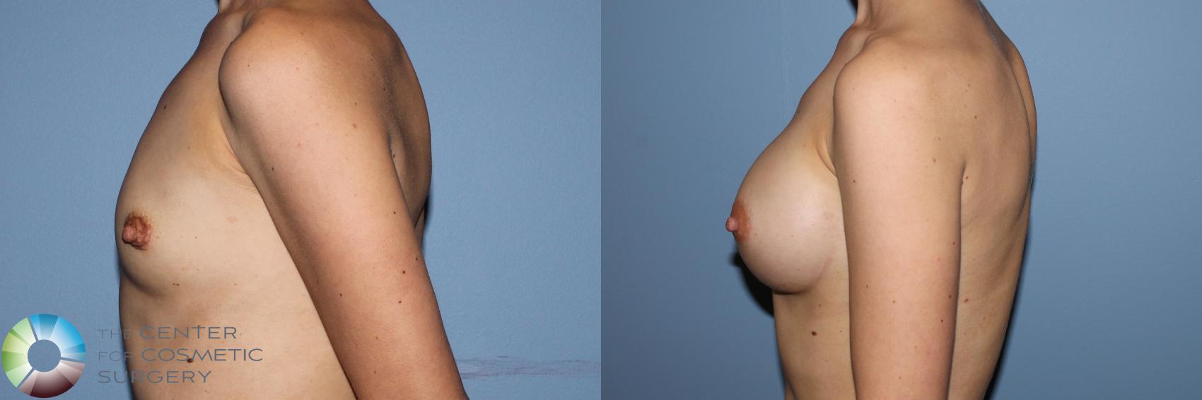 Before & After Breast Augmentation Case 11703 Left Side View in Golden, CO