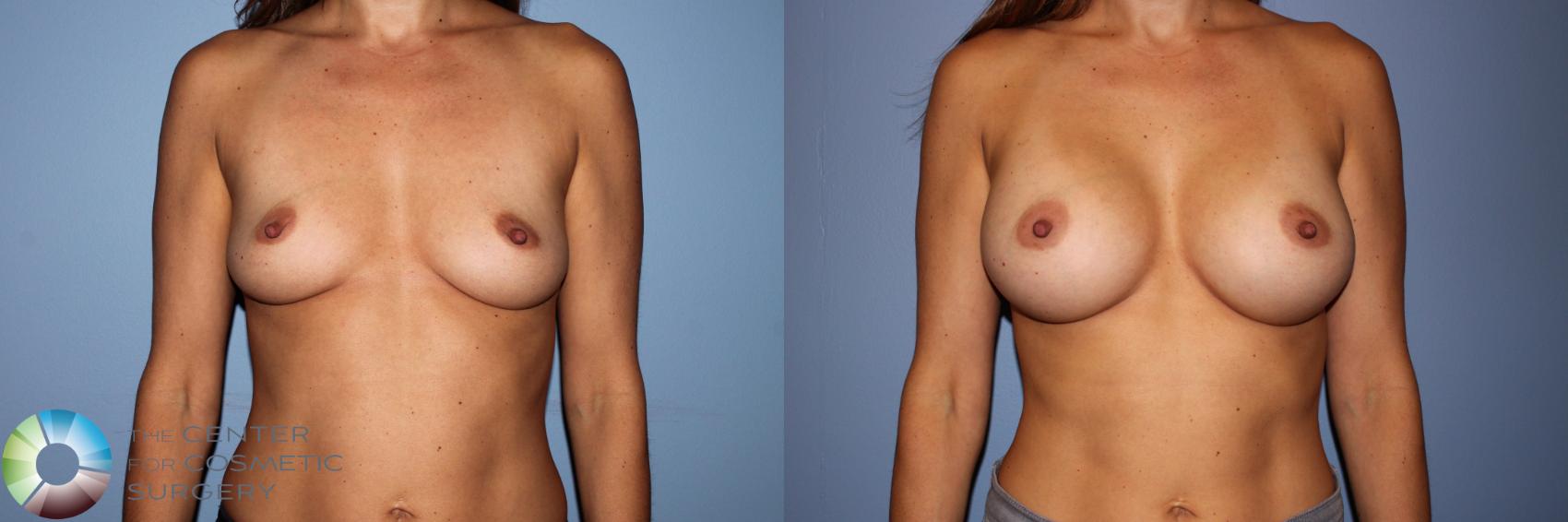 Before & After Breast Augmentation Case 11704 Front in Denver and Colorado Springs, CO