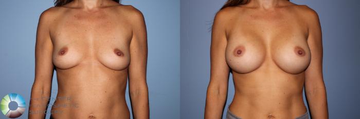 Before & After Breast Augmentation Case 11704 Front View in Golden, CO