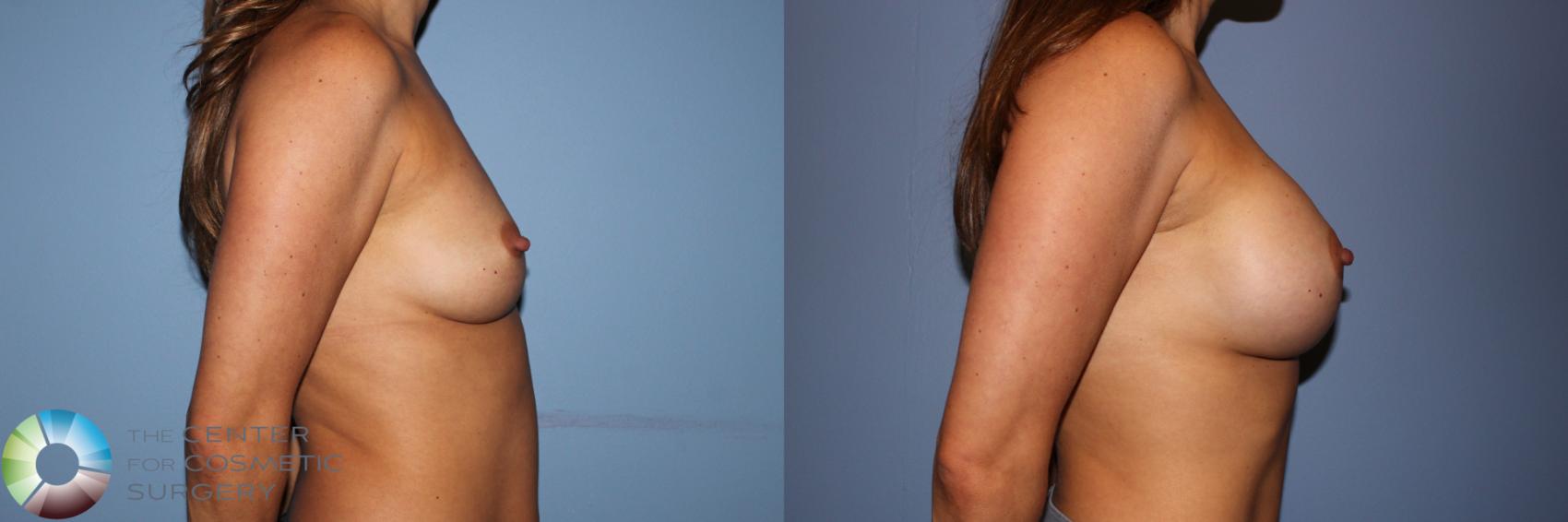 Before & After Breast Augmentation Case 11704 Right Side View in Golden, CO