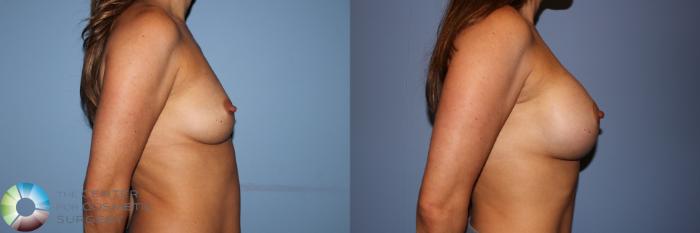 Before & After Breast Augmentation Case 11704 Right Side View in Golden, CO