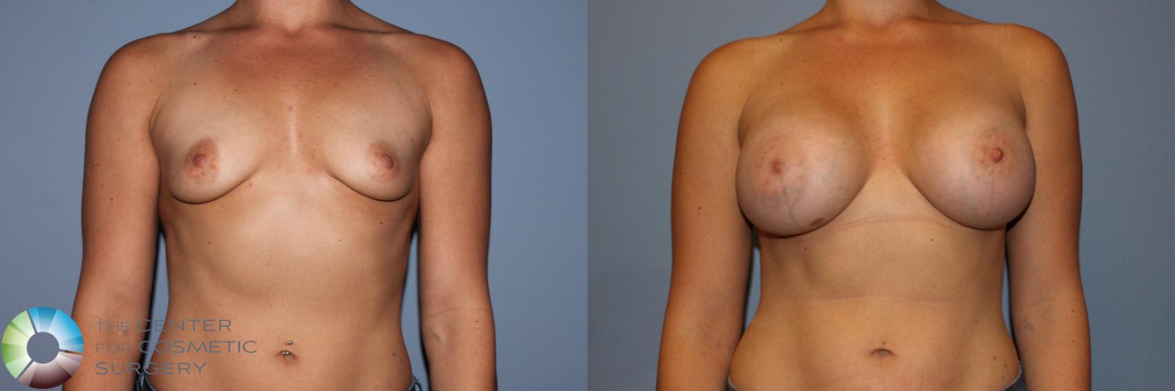 Before & After Breast Augmentation Case 11706 Front View in Golden, CO
