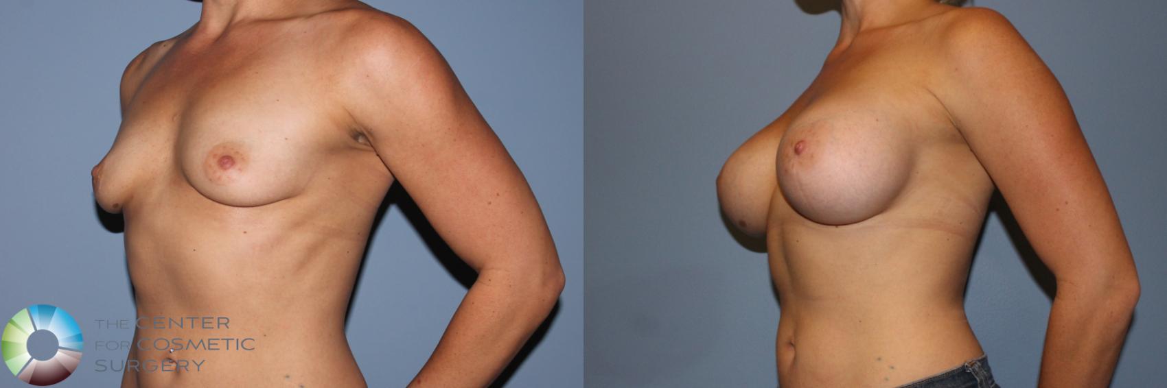 Before & After Breast Augmentation Case 11706 Left Oblique View in Golden, CO