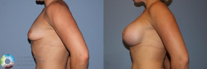 Before & After Breast Augmentation Case 11706 Left Side View in Golden, CO