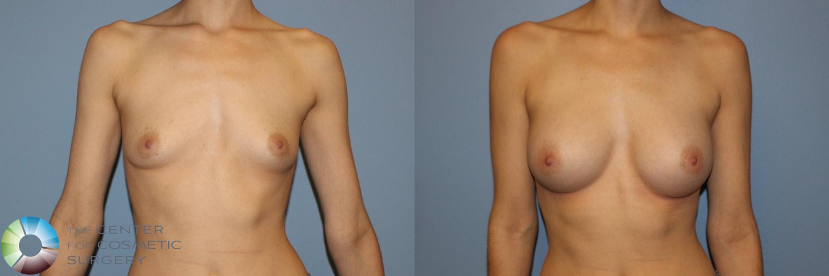 Before & After Breast Augmentation Case 11707 Front View in Golden, CO