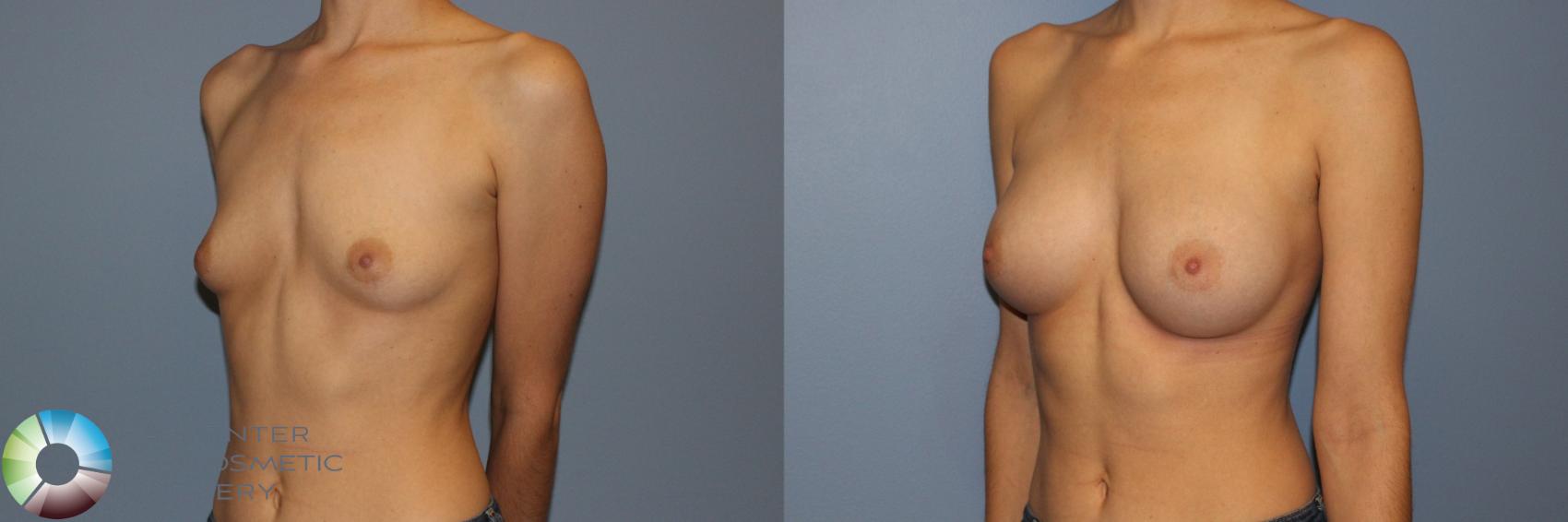 Before & After Breast Augmentation Case 11707 Left Oblique View in Golden, CO