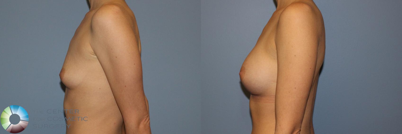 Before & After Breast Augmentation Case 11707 Left Side View in Golden, CO