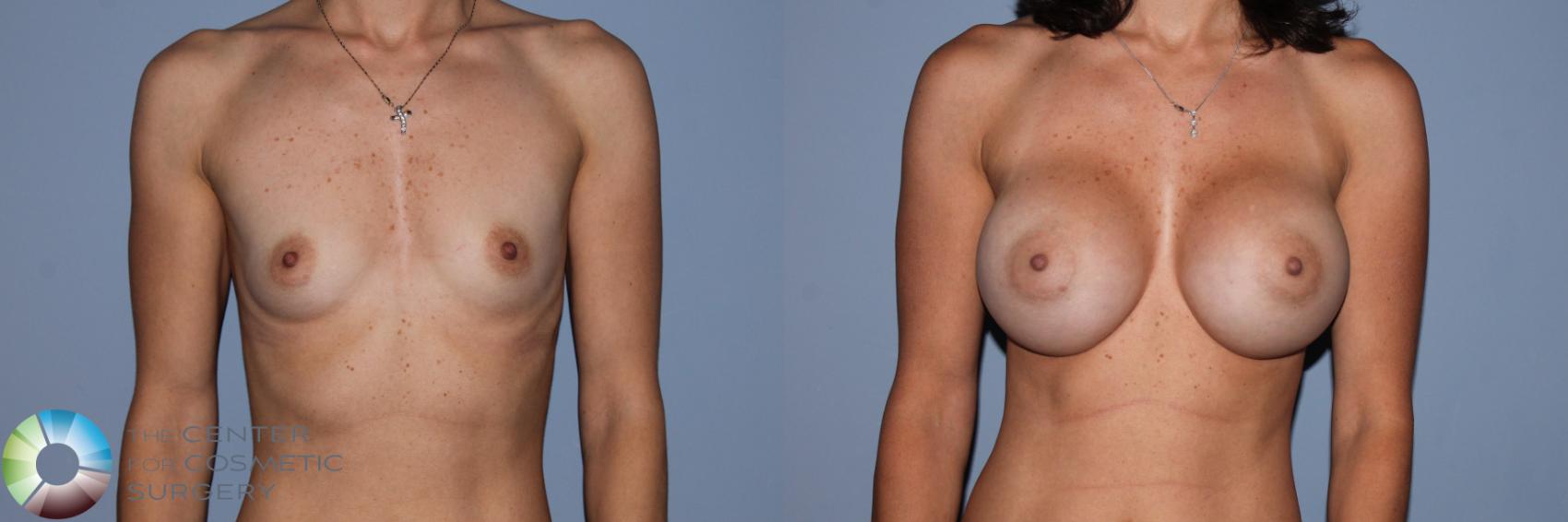 Before & After Breast Augmentation Case 11708 Front in Denver, CO