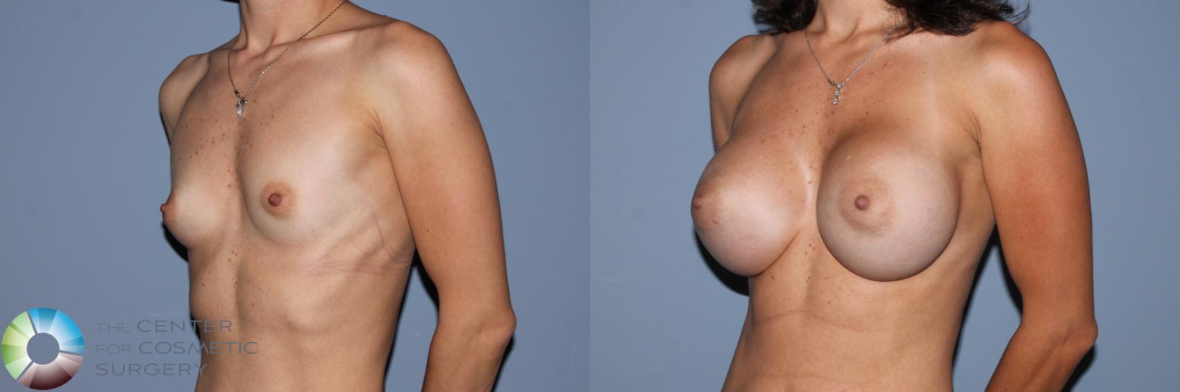 Before & After Breast Augmentation Case 11708 Left Oblique in Denver and Colorado Springs, CO