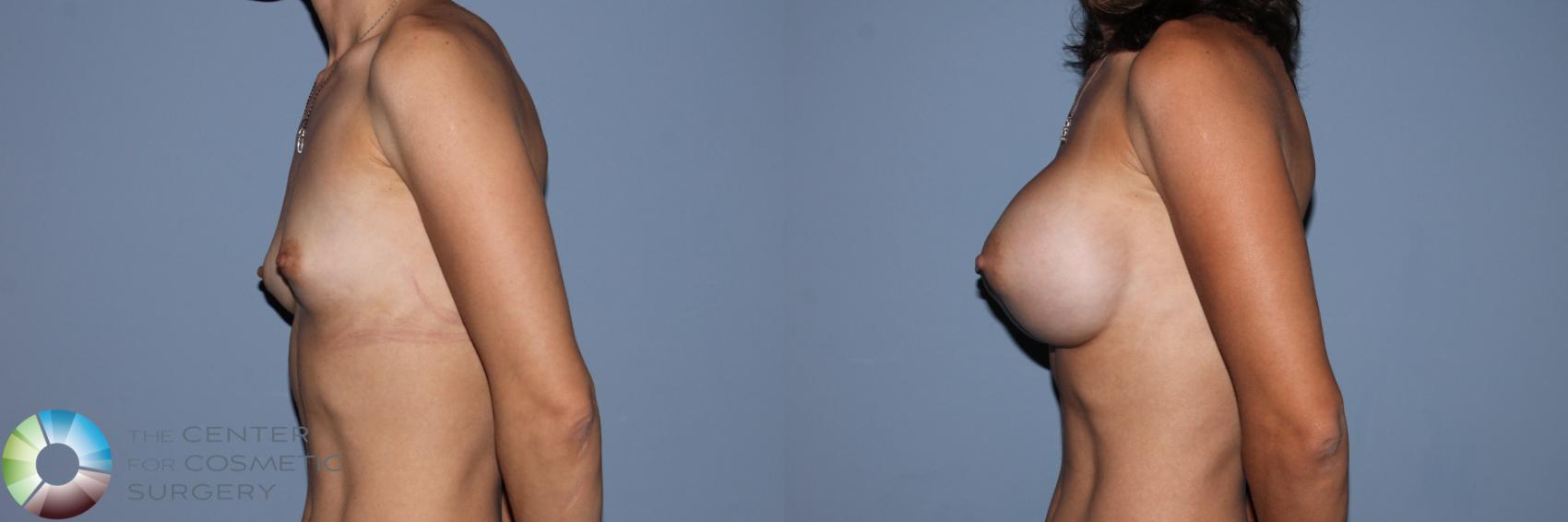 Before & After Breast Augmentation Case 11708 Left Side in Denver and Colorado Springs, CO