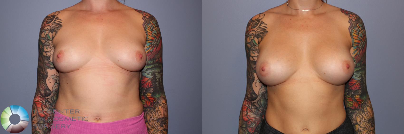 Before & After Breast Augmentation Case 11710 Front View in Golden, CO