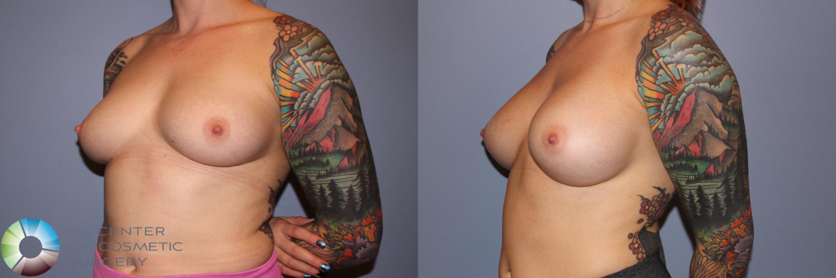 Before & After Breast Augmentation Case 11710 Left Oblique View in Golden, CO