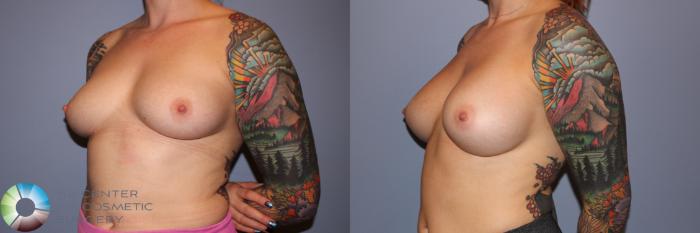 Before & After Breast Augmentation Case 11710 Left Oblique View in Golden, CO