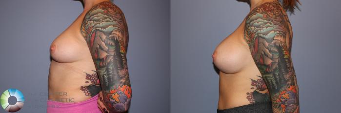 Before & After Breast Augmentation Case 11710 Left Side View in Golden, CO