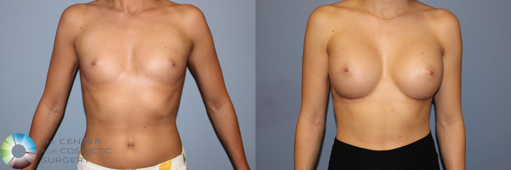 Before & After Breast Augmentation Case 11711 Front View in Golden, CO