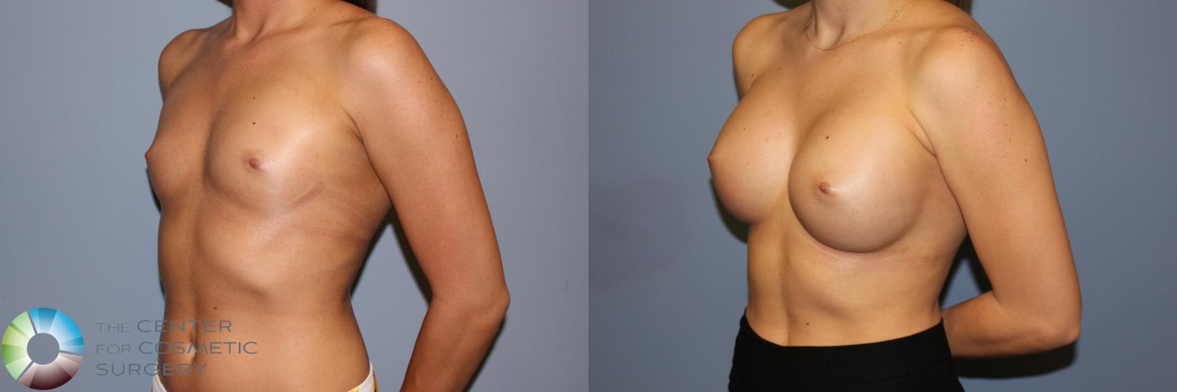 Before & After Breast Augmentation Case 11711 Left Oblique in Denver and Colorado Springs, CO