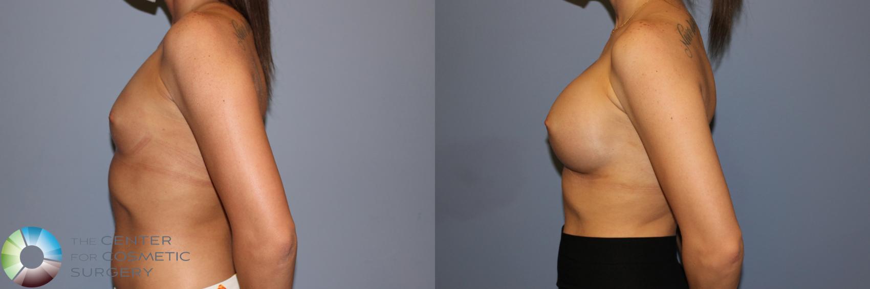 Before & After Breast Augmentation Case 11711 Left Side in Denver and Colorado Springs, CO