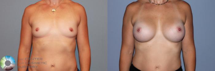 Before & After Breast Augmentation Case 11712 Front in Denver and Colorado Springs, CO