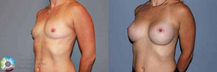 Before & After Breast Augmentation Case 11712 Left Oblique in Denver and Colorado Springs, CO