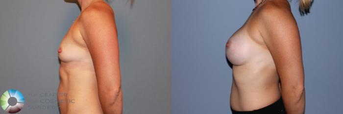 Before & After Breast Augmentation Case 11712 Left Side in Denver and Colorado Springs, CO