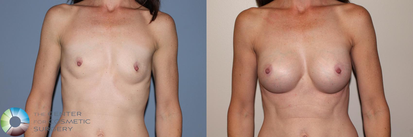 Before & After Breast Augmentation Case 11713 Front in Denver and Colorado Springs, CO