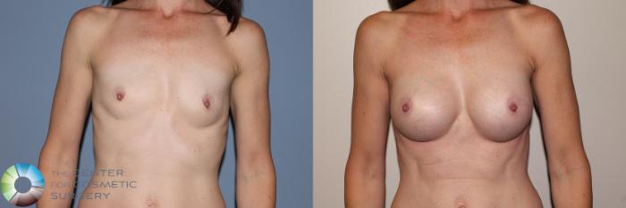 Before & After Breast Augmentation Case 11713 Front View in Golden, CO