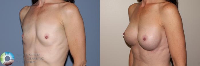 Before & After Breast Augmentation Case 11713 Left Oblique View in Golden, CO