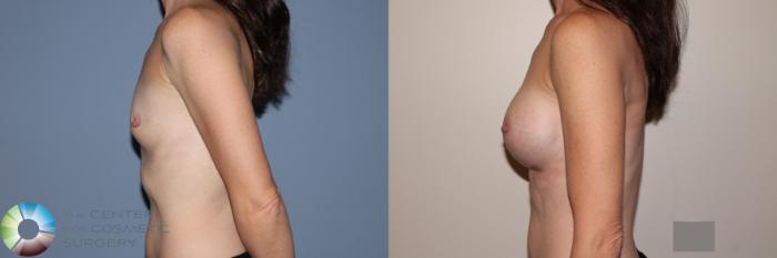 Before & After Breast Augmentation Case 11713 Left Side View in Golden, CO