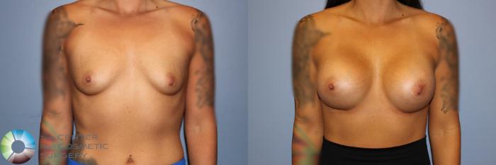 Before & After Breast Augmentation Case 11715 Front View in Golden, CO