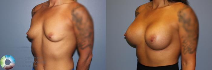 Before & After Breast Augmentation Case 11715 Left Oblique View in Golden, CO