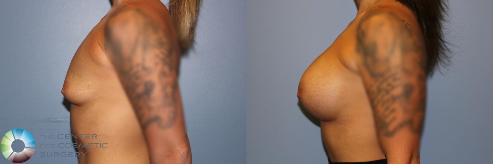 Before & After Breast Augmentation Case 11715 Left Side View in Golden, CO