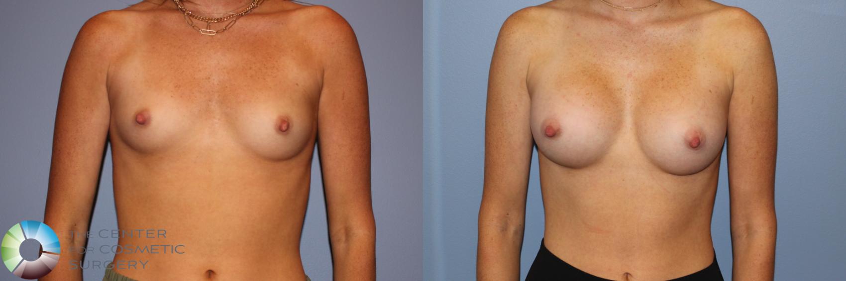 Before & After Breast Augmentation Case 11717 Front in Denver and Colorado Springs, CO