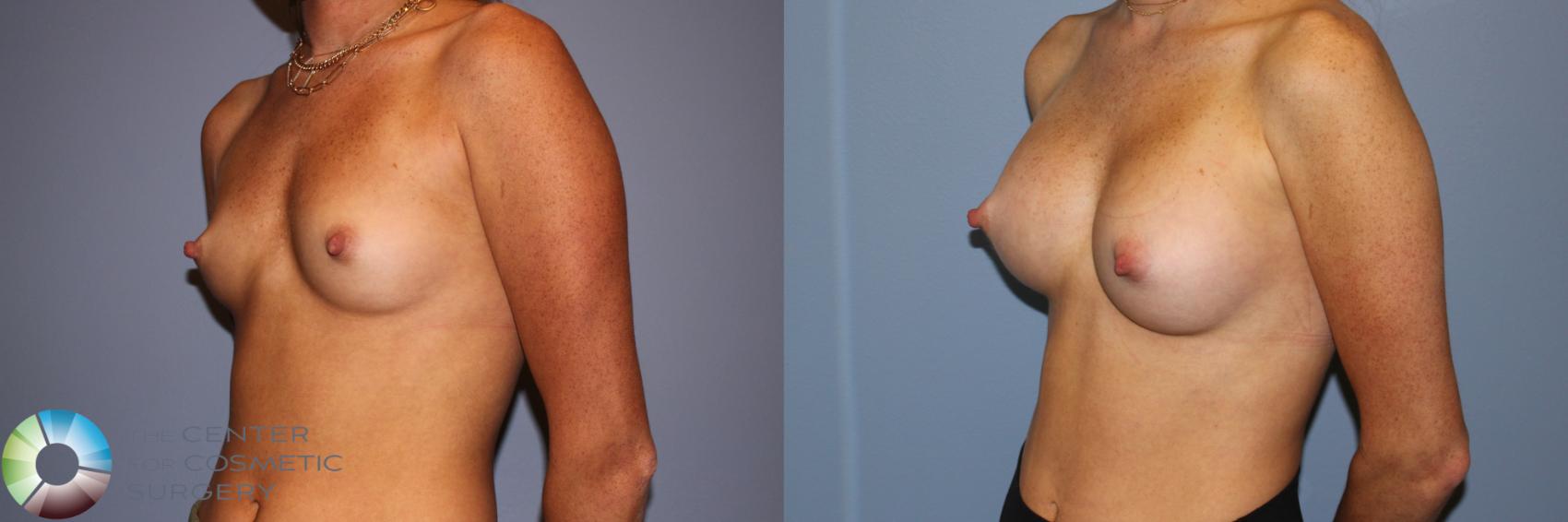Before & After Breast Augmentation Case 11717 Left Oblique View in Golden, CO