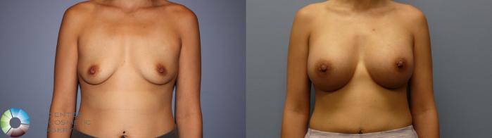 Before & After Breast Augmentation Case 11719 Front View in Golden, CO