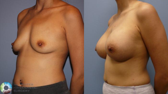 Before & After Breast Augmentation Case 11719 Left Oblique View in Golden, CO