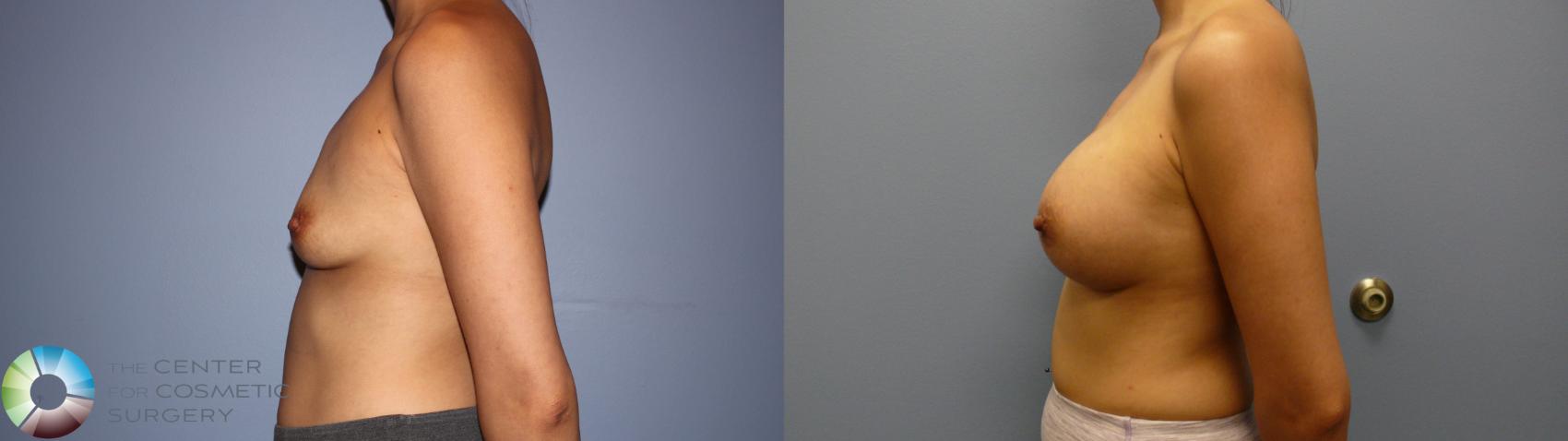 Before & After Breast Augmentation Case 11719 Left Side in Denver and Colorado Springs, CO
