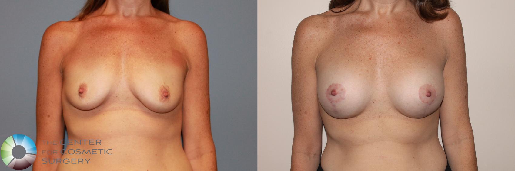 Before & After Breast Augmentation Case 11724 Front View in Golden, CO