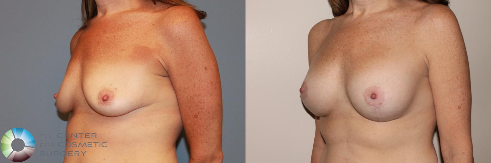 Before & After Breast Augmentation Case 11724 Left Oblique in Denver and Colorado Springs, CO