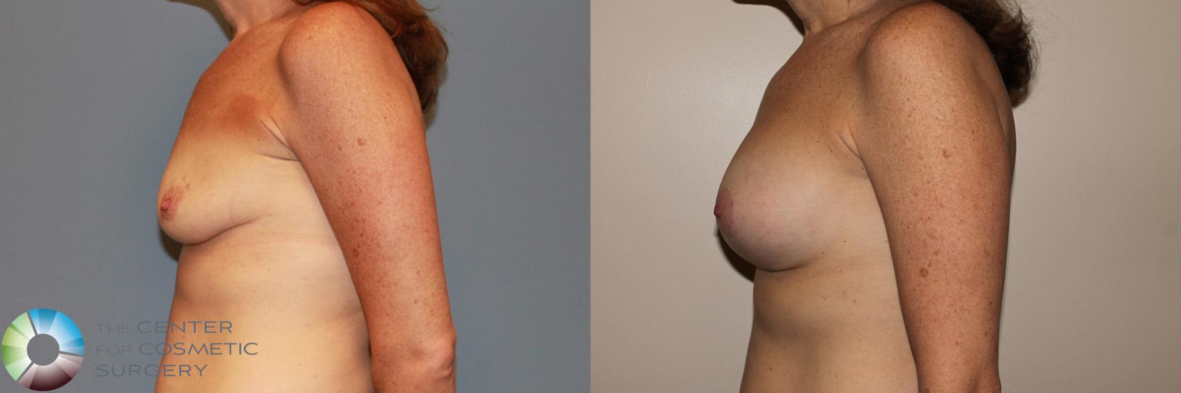 Before & After Breast Augmentation Case 11724 Left Side in Denver and Colorado Springs, CO