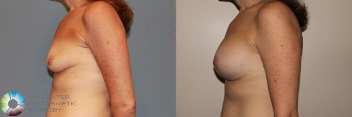 Before & After Breast Augmentation Case 11724 Left Side View in Golden, CO
