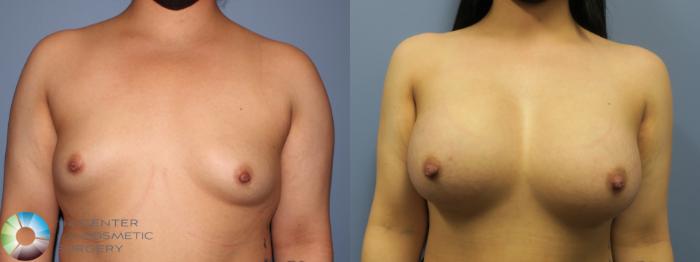 Before & After Breast Augmentation Case 11725 Front in Denver, CO