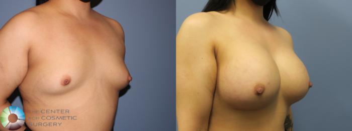 Before & After Breast Augmentation Case 11725 Right Oblique in Denver, CO
