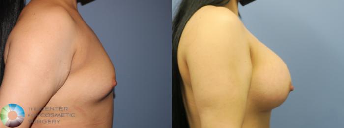 Before & After Breast Augmentation Case 11725 Right Side in Denver, CO
