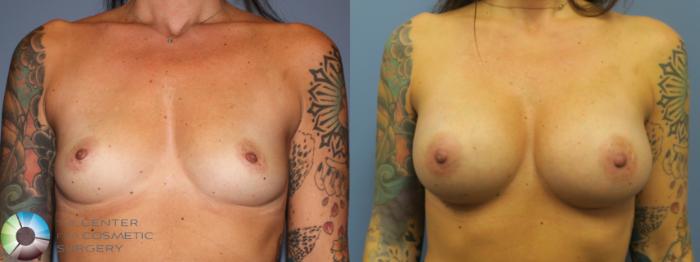 Before & After Breast Augmentation Case 11726 Front in Denver and Colorado Springs, CO