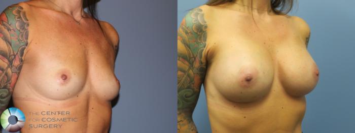 Before & After Breast Augmentation Case 11726 Right Oblique in Denver and Colorado Springs, CO