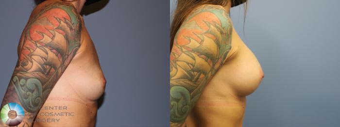Before & After Breast Augmentation Case 11726 Right Side in Denver and Colorado Springs, CO