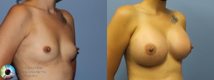 Before & After Breast Augmentation Case 11727 Right Oblique View in Golden, CO
